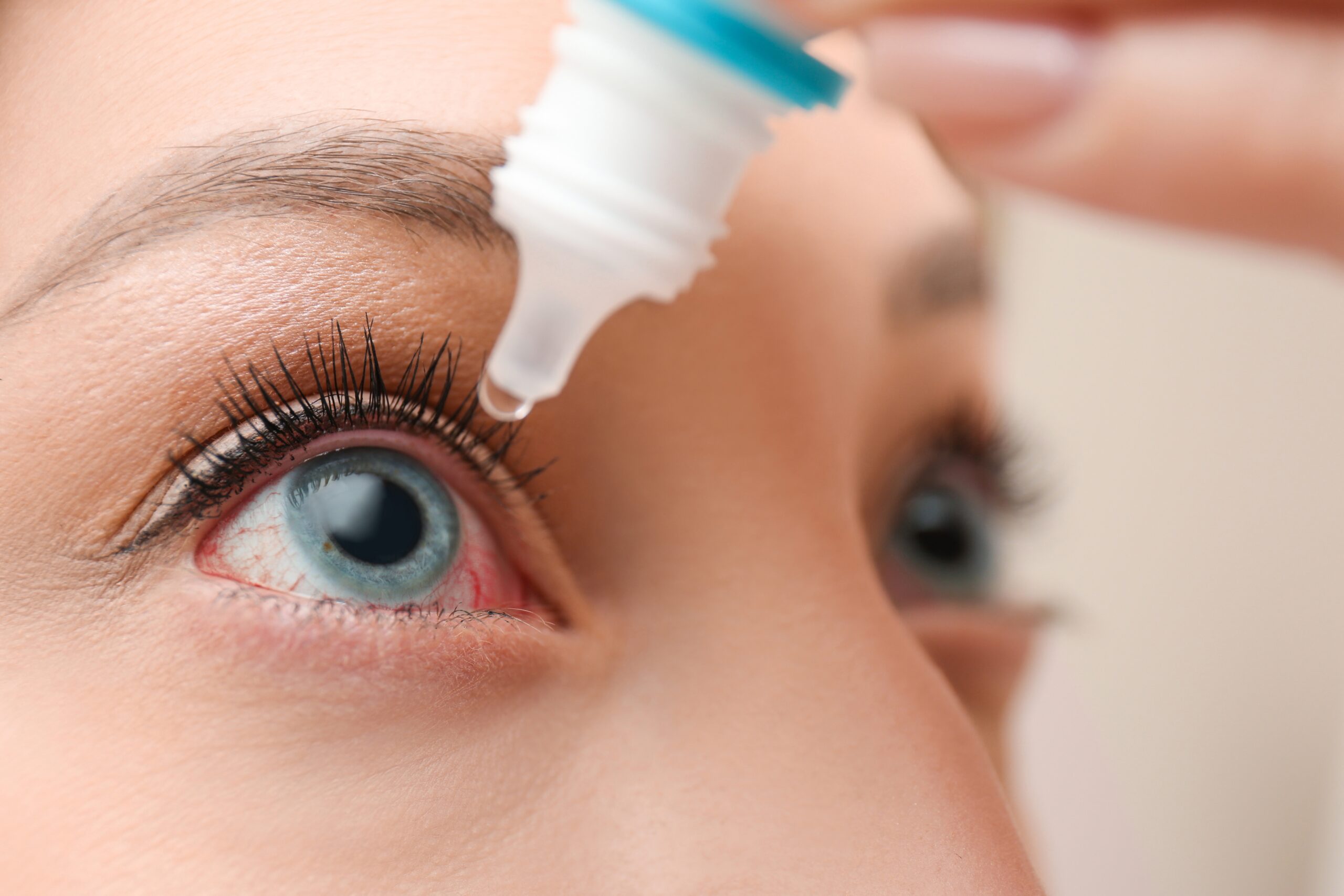 Closeup,View,Of,Woman,Using,Eye,Drops